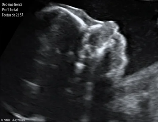 Profil foetal à 22 SA de grossesse - Oedème frontal