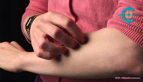 Une personne se grattant l'avant-bras pour soulager des démangeaisons, illustrant le ressenti des patients.
