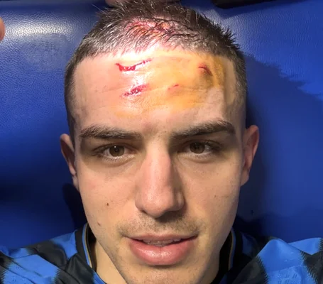 Nikola Krstovic affiche les marques sur son front après le coup de crampons de Ramy Bensebaïni.