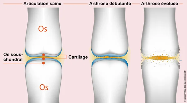Illustration comparant les états d'une articulation saine, d'arthrose débutante et d'arthrose évoluée.