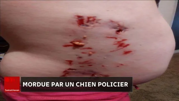 Morsures rouges et sanglantes sur le bas du dos d'une victime de chien policier.
