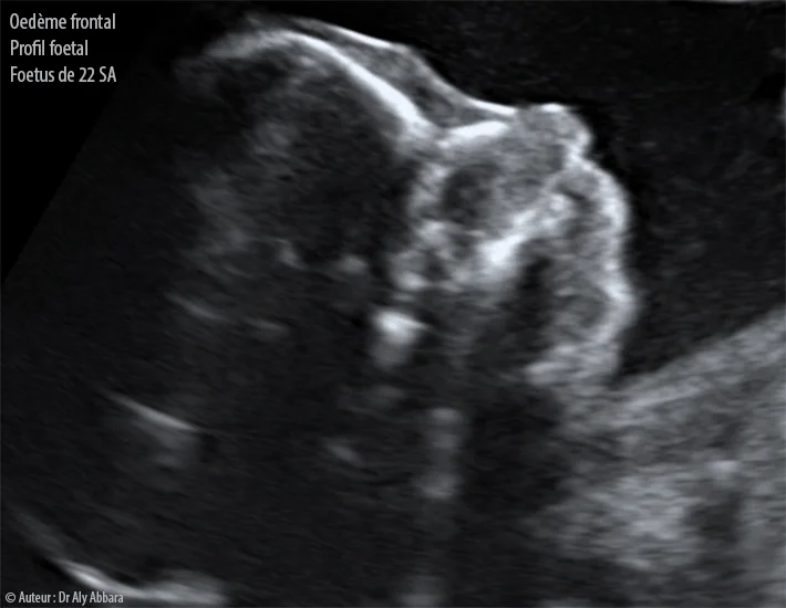 Profil foetal à 22 SA de grossesse - Oedème frontal