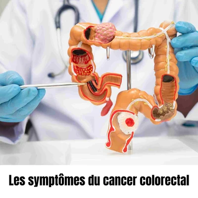 Les symptômes du cancer colorectal illustrés par un modèle anatomique.