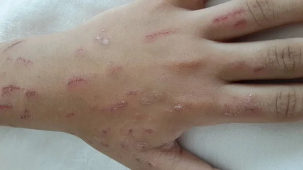 Main présentant des rougeurs, des irritations et des zones squameuses typiques d'un cas de maladie de Morgellons.