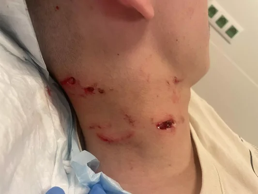 Blessures multiples sur le cou d'un jeune homme mordu par un chien policier à Rillieux-la-Pape, en milieu médical.