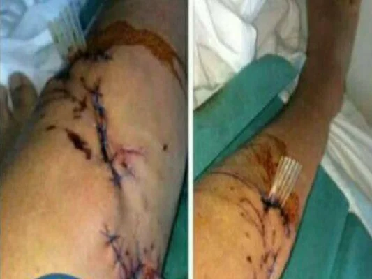 Double vue des plaies suturées sur la jambe d'un adolescent mordu par un chien policier à Rillieux-la-Pape.