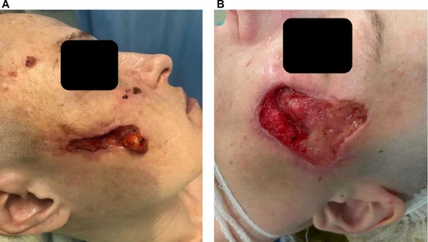 Gros plans de lésions faciales avec tissu inflammatoire et objet proéminent, illustrant la corrélation clinique de la maladie de Morgellons.