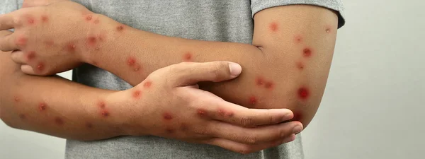 Lésions cutanées rouges et surélevées sur les bras d'une personne, symptômes associés au mpox.