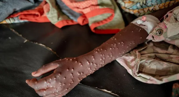 Lésions cutanées de la mpox visibles sur un bras en RDC.