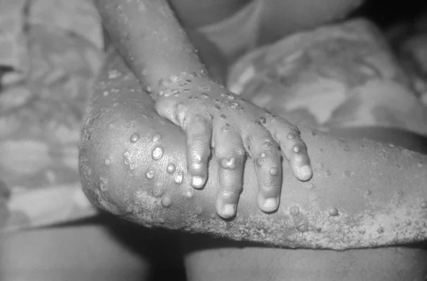 Lésions du mpox sur le bras et la main d'une fillette de 4 ans à Bondua, au Liberia, causées par un virus de type variole