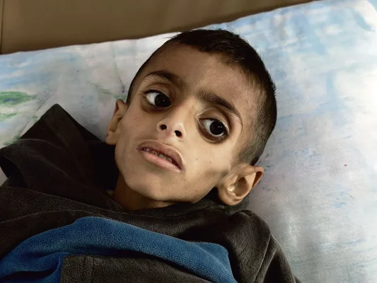 Un enfant allongé sur un lit, le regard fixe, témoignant des conditions critiques à Gaza.