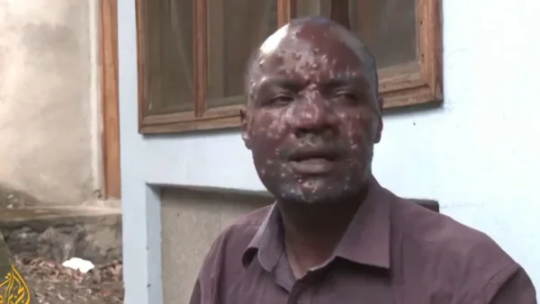 Visage d'un patient atteint de mpox avec des lésions cutanées en RDC.