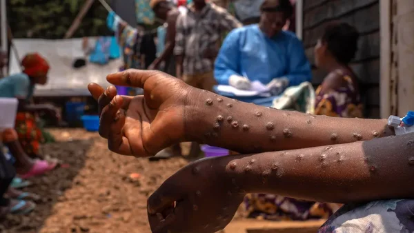 Bras couverts de lésions de mpox avec du personnel soignant en arrière-plan.