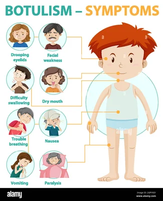 Infographie sur les symptômes du botulisme.