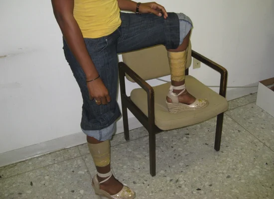 Jambes bandées d'une mule de la drogue avec des paquets d'héroïne dissimulés sous les bandages, lors d'un contrôle des douanes américaines.
