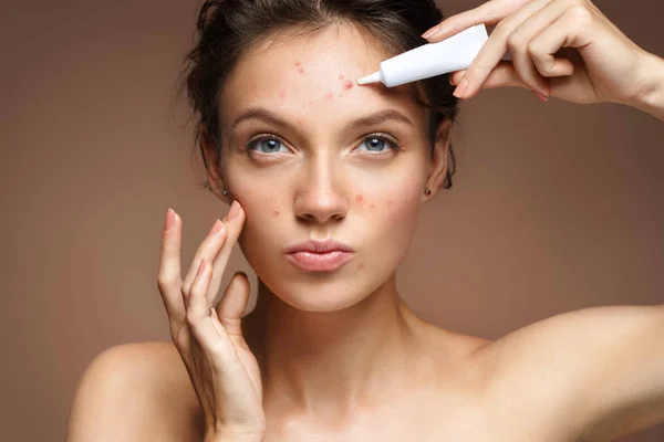 Dans le cadre des médicaments de l'acné, jeune femme avec acné sur le front et les joues appliquant un soin ciblé depuis un petit tube blanc, regard neutre vers l'objectif.