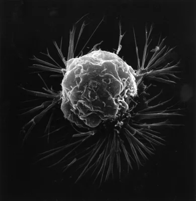 Une cellule de cancer du sein observée au microscope électronique à balayage, présentant de nombreux filopodes s'étendant à partir de sa surface, image en trois dimensions de la cellule cancéreuse.
