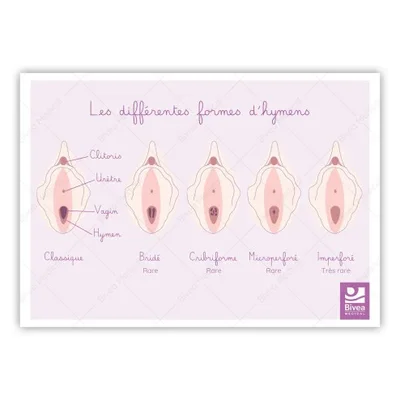 Infographie médicale étiquetée en français présentant les différentes formes anatomiques de l'hymen, avec des légendes telles que 'Classique', 'Bridé' et 'Imperforé'