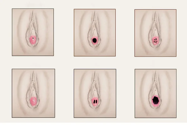 Six illustrations médicales à la main montrant des variations de l'ouverture vaginale et l'anatomie de l'hymen chez la femme