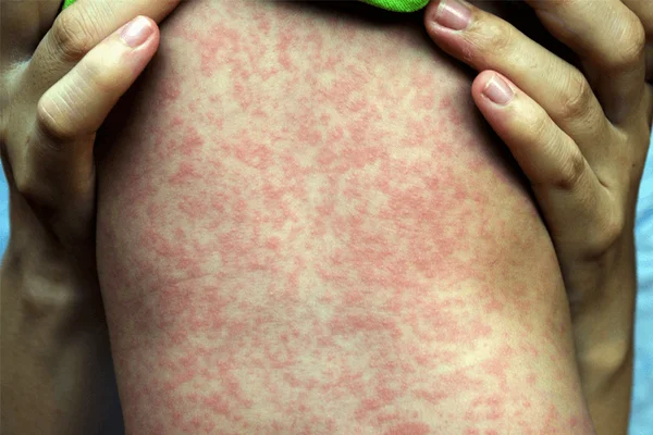 Gros plan sur le dos d'un enfant couvert d'une éruption maculopapuleuse rouge étendue caractéristique de la rougeole, avec les mains d'un adulte posées sur ses épaules