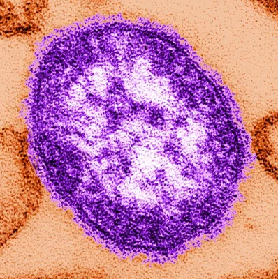 Micrographie électronique colorisée montrant une particule sphérique du virus de la rougeole à enveloppe texturée, en violet sur fond orange-brun