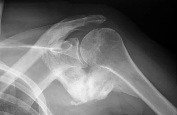 Radiographie médicale d'une articulation de l'épaule montrant une ossification hétérotopique avec calcifications irrégulières et érosion osseuse autour de la tête humérale et de la glène