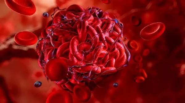 Illustration 3D d'un caillot sanguin composé de globules rouges emprisonnés dans un maillage de fibrine, flottant parmi d'autres globules rouges dans un vaisseau sanguin