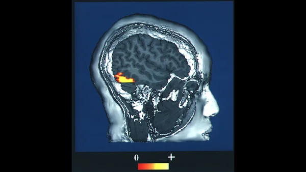 Scan MRI sagittal d'un crâne humain montrant une zone d'intensité élevée colorée en jaune/orange dans la région postérieure du cerveau, indiquant une lésion ou anomalie cérébrale